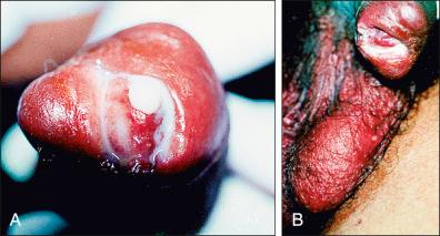 Figure 26-9, Urethritis together with gonococcal balanoposthitis with considerable edema and scabbing in the scrotum. The pus accumulated between the glans and the preputium, causing the deformity. Serology for human immunodeficiency virus was negative. The VDRL test was reactive 1 : 64.