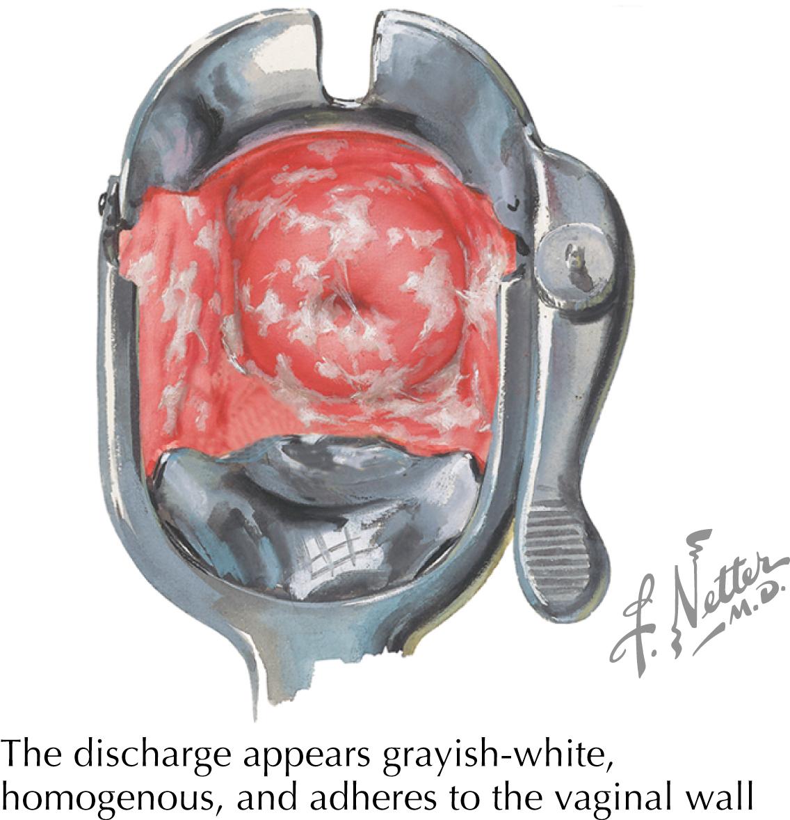 Fig. 61.1, Discharge of bacterial vaginosis.