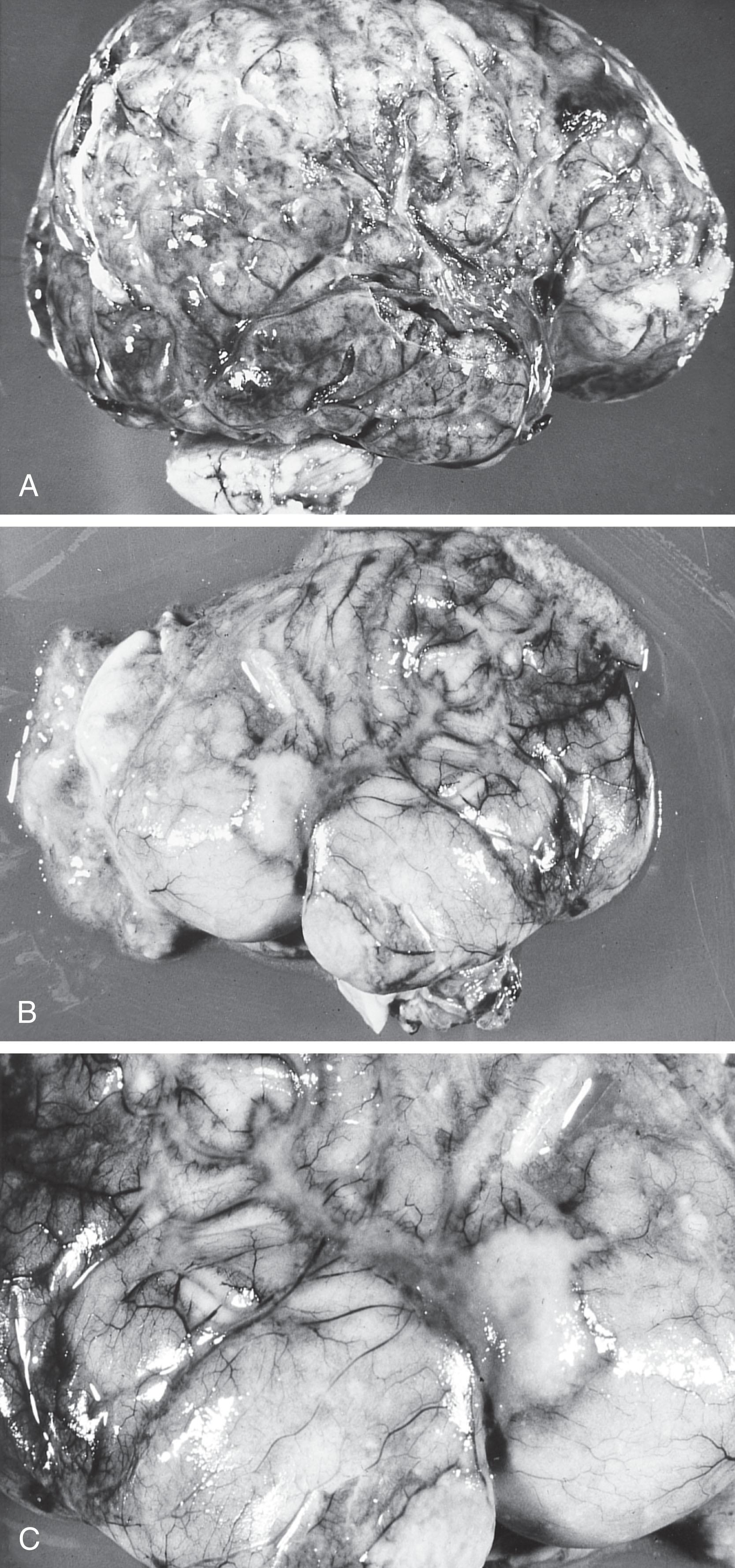 Fig. 39.2, Neonatal bacterial meningitis: arachnoidal exudate. (A) From an infant with group B streptococcal meningitis who died at 12 days of age. This right lateral view of the cerebrum shows thick arachnoidal exudate. (B) From an infant who died at 13 days of age with Escherichia coli meningitis. This left lateral view of the cerebrum shows thick arachnoidal exudate, especially prominent in the region of the sylvian fissure. (C) Closer view of the exudate in the region of the sylvian fissure.