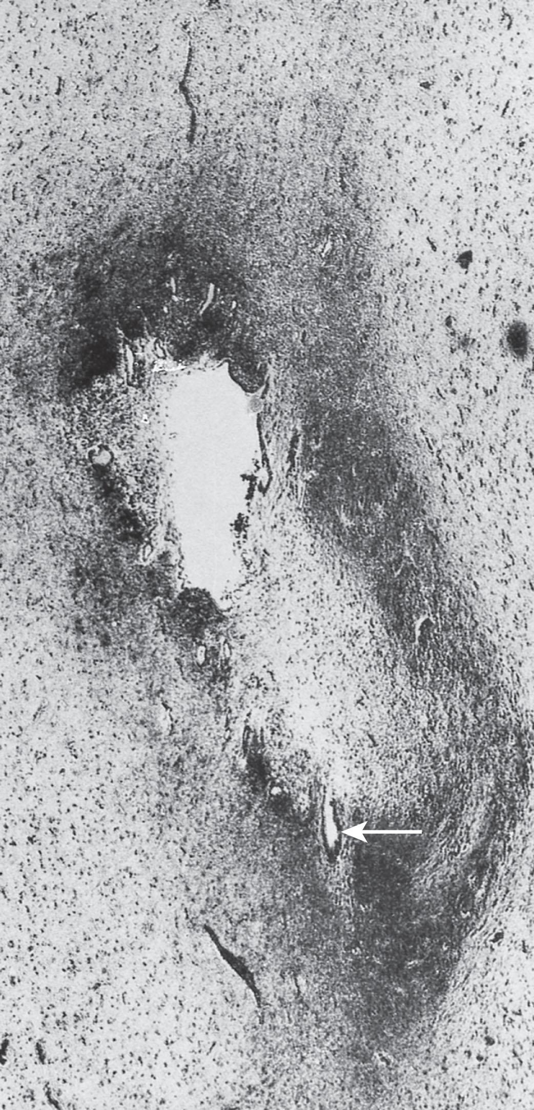 Fig. 39.3, Aqueductal obstruction subsequent to ventriculitis from an infant who died of neonatal bacterial meningitis. Stain for glial fibers shows formation of glial bridges that have narrowed and partially occluded the aqueduct. The lower portion of the aqueduct is reduced to a small slit ( arrow ) (phosphotungstic acid hematoxylin, ×100).