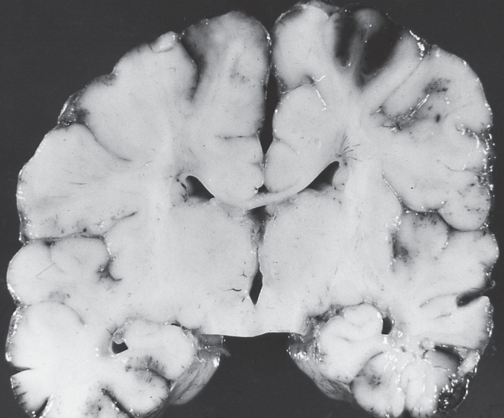 Fig. 39.4, Cerebral edema with neonatal bacterial meningitis. Coronal section of the brain from the same infant shown in Fig. 39.2A . Note the diffusely swollen appearance of the cerebral parenchyma, resulting in flattened gyri and small, slitlike ventricles. Purulent material is evident in the ventricles (medial aspect), and a hemorrhagic infarct is apparent in the parasagittal region.