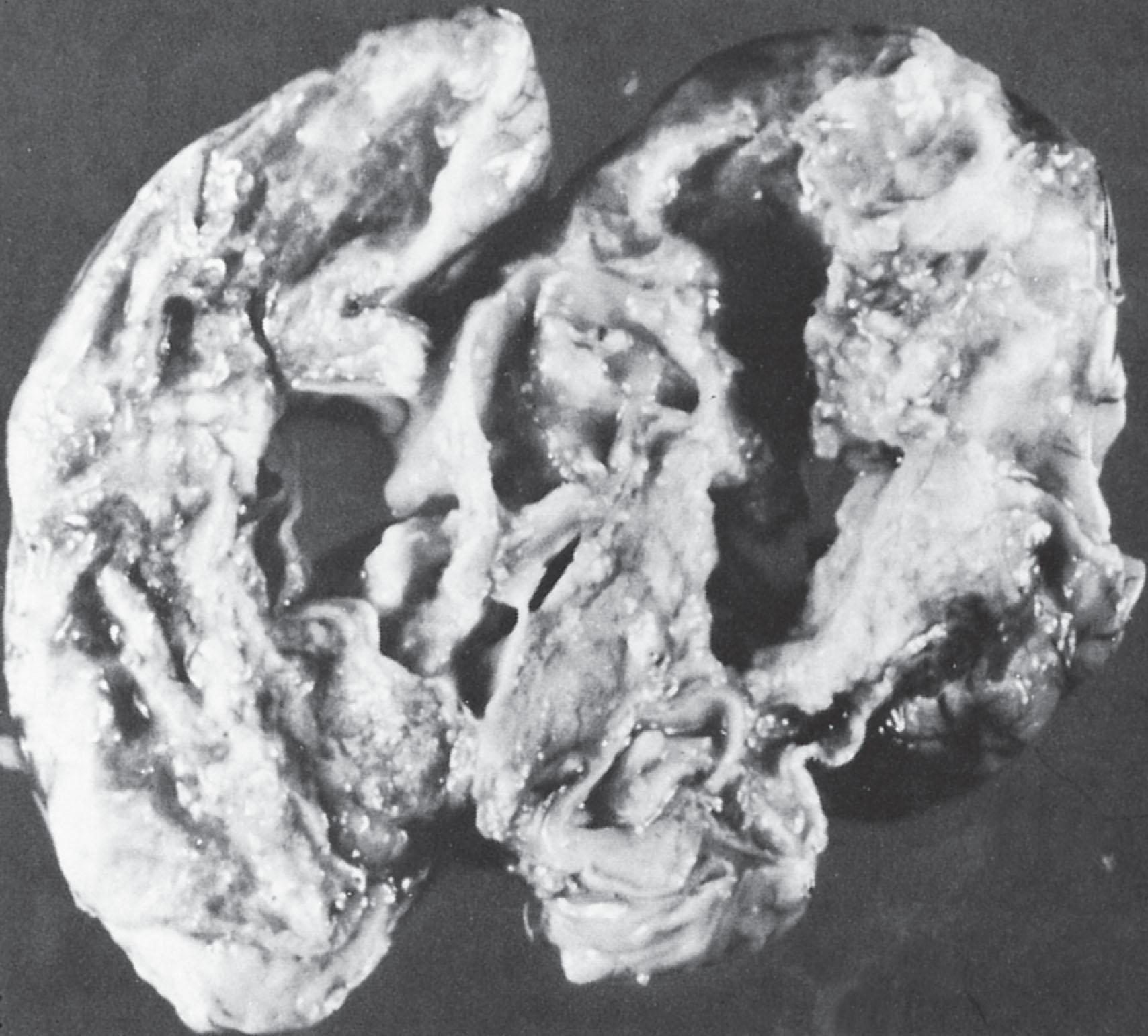 Fig. 39.6, Multicystic encephalomalacia following neonatal bacterial meningitis: neuropathology. From an infant with neonatal gram-negative bacterial meningitis who died at 5 weeks of age. This coronal section of the cerebrum shows that the cerebral hemispheres have been converted into a necrotic mass with many cystic cavities of various sizes. The corpus callosum is necrotic, and the ventricles cannot be delineated from cystic spaces in the brain.