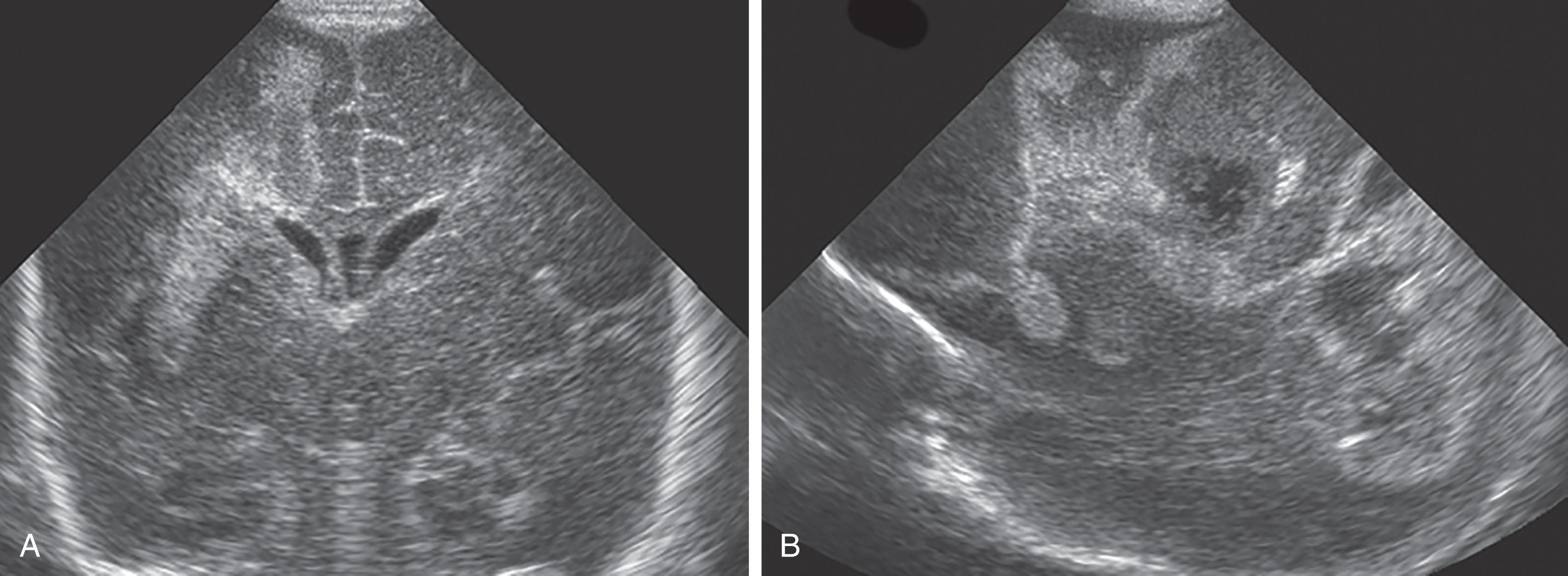 Fig. 39.8, Bacillus cereus meningitis: ultrasound scans. Coronal (A) and parasagittal views (B) showing an irregular pattern with extensive areas of increased echogenicity in cerebral white matter, with development of echolucencies seen within 24 hours after the first symptoms of the meningitis.