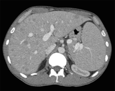 Fig. 40-2, Computed tomography (CT) of abdomen showing hepatosplenomegaly with innumerable hepatic microabscesses in a patient with HIV and salmonellosis.