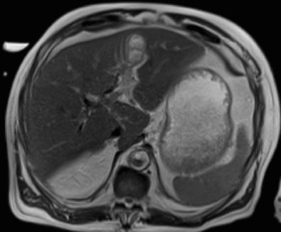 Fig. 40-3, Magnetic resonance imaging (MRI) of abdomen showing left hepatic lobe intrahepatic abscess in a patient with emphysematous cholecystitis.