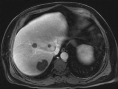 Fig. 40-4, Magnetic resonance imaging (MRI) of the abdomen showing multiple hepatic abscesses in the right hepatic lobe in a patient with Streptococcus intermedius bacteremia.