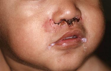 FIGURE 32-2, Impetigo presents with honey-crusted to dark crusts. Nasal carriage is common.