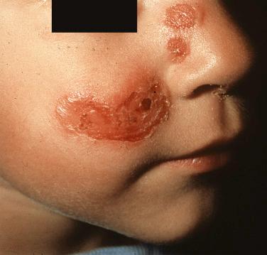 FIGURE 32-3, Bullous impetigo presents with evanescent blisters that rupture quickly leaving a denuded area with a rim of scale.