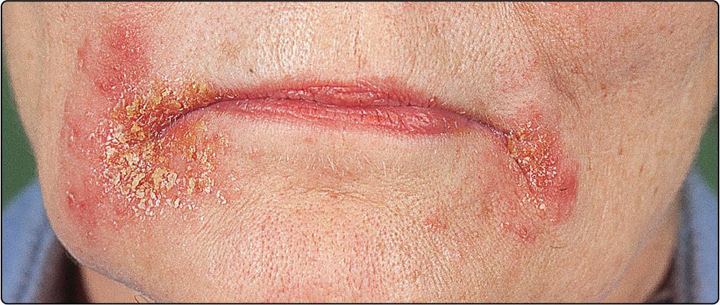 Fig. 27.1, Impetigo of the face due to Staphylococcus aureus.