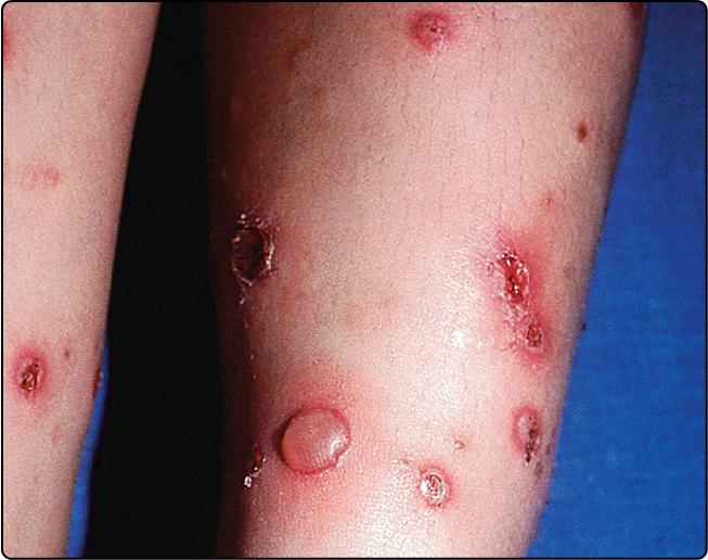 Fig 27.2, Bullous impetigo results from staphylococcal toxin production.