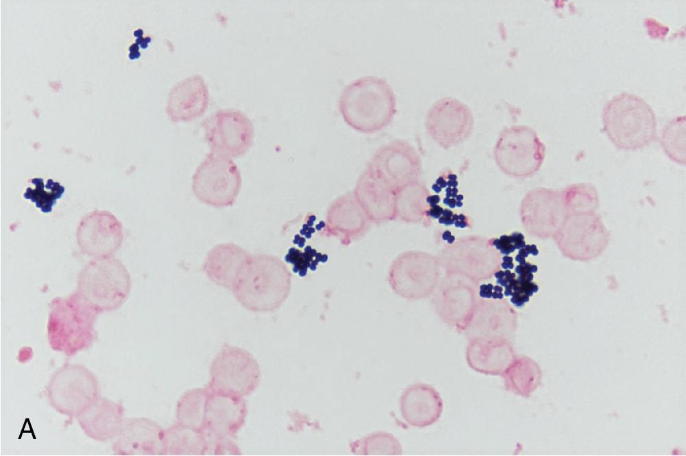 FIGURE 84.2, Representative images of Gram stain morphologies. (A) Gram-positive cocci in clusters; (B) lancet-shaped gram-positive cocci in pairs; (C) gram-positive cocci in pairs and chains; (D) regular gram-positive rods; (E) coryneform gram-positive rods; (F) beaded gram-positive rods; (G) beaded, branching, filamentous gram-positive rods; (H) branching, filamentous gram-positive rods (not beaded); (I) gram-variable rods; (J) gram-negative rods; (K) fusiform gram-negative rods; (L) curved gram-negative rods; (M) gram-negative diplococci; (N) gram-negative coccobacilli.