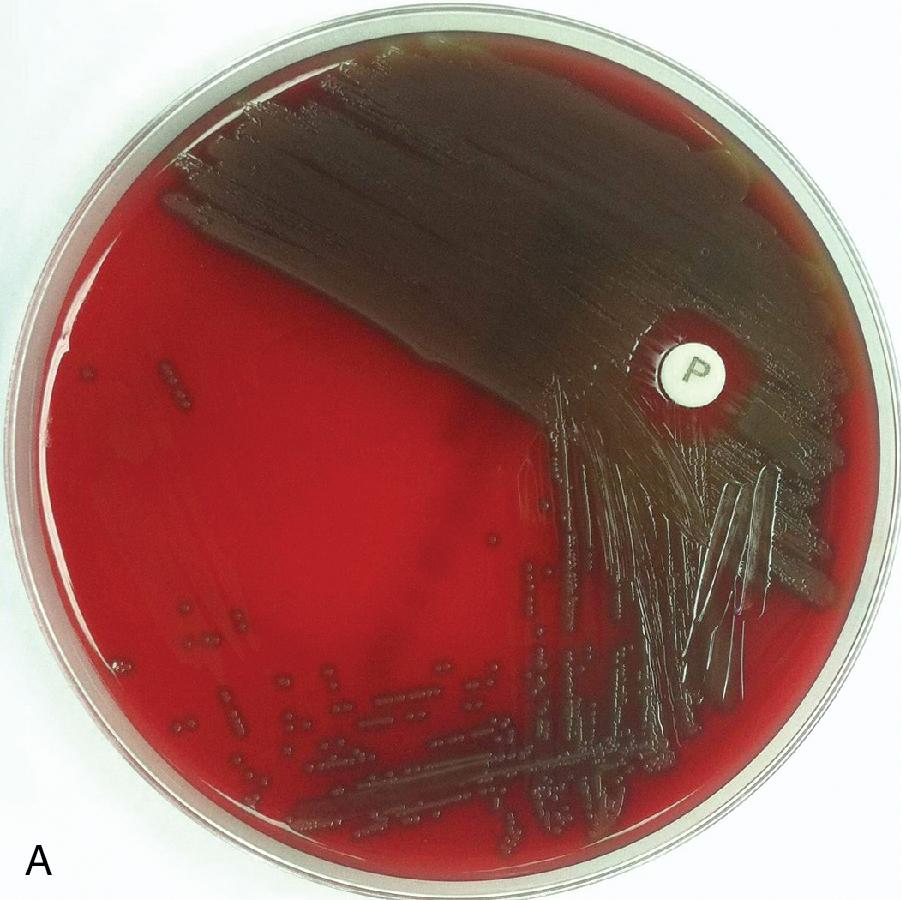 FIGURE 84.3, Representative images of various media and bacterial colony morphologies. (A) Alpha hemolysis on blood agar plate (BAP); (B) ß-hemolysis on BAP; (C) lactose fermentation on MacConkey agar (MAC); (D) nonlactose fermentation on MAC; (E) Bacteroides bile esculin (BBE) agar; (F) Burkholderia cepacia agar; (G) bullseye colony on cefsulodin-irgasan-novobiocin (CIN) agar; (H) colonies with hydrogen sulfide (H 2 S) production (black pigment) on hektoen enteric (HE) agar; (I) green colonies with no H 2 S production on HE agar; (J) yellow colonies on mannitol salt agar (MSA); (K) yellow colonies on thiosulfate citrate bile salts sucrose (TCBS) agar.