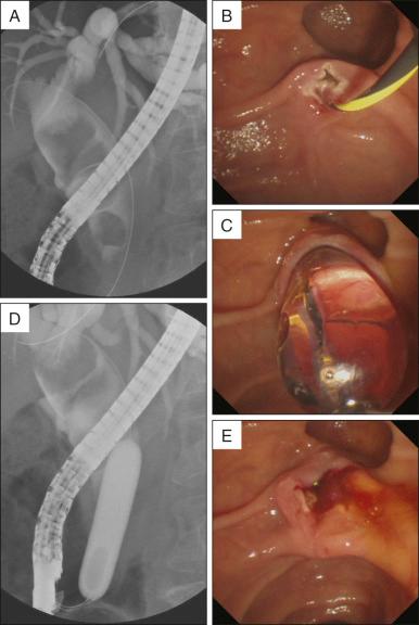FIG 18.1, A case of large-balloon dilation after minimal EST in a patient with multiple large extrahepatic bile duct stones. A, Retrograde cholangiogram shows multiple large stones that completely fill the extrahepatic bile duct. B–D, After minimal EST, a large balloon is inflated up to 15 mm over the guidewire and through the sphincterotomized papilla. E, The papillary orifice is dilated fully and the bile duct mucosa is readily seen. EST, Endoscopic sphincterotomy.