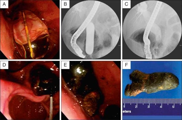 FIG 18.2, A huge stone is impacted at the bile duct bifurcation. After sphincterotomy, large-balloon dilation is performed up to 18 mm. A and B, Removal with a large basket catheter and mechanical lithotriptor fails, and retrieval of a large stone is attempted with a retrieval balloon catheter (C) . D, The stone is pulled out with a retrieval balloon catheter and extracted from the papilla. E and F, A huge stone (4.5 cm × 2.0 cm) is finally evacuated without crushing.