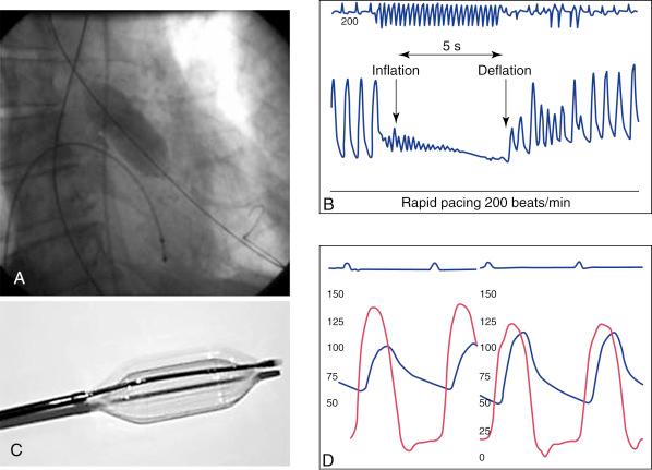 Fig. 53.1, Balloon aortic valvuloplasty (A) is performed under rapid ventricular pacing (B), which decreases the effective cardiac output by inducing ventricular tachycardia. The balloon catheter (C) must be sized to the aortic annulus to avoid severe aortic insufficiency. Doubling of the valve area or decreasing the transvalvular gradient by greater than 50% (D) is considered a successful procedure.