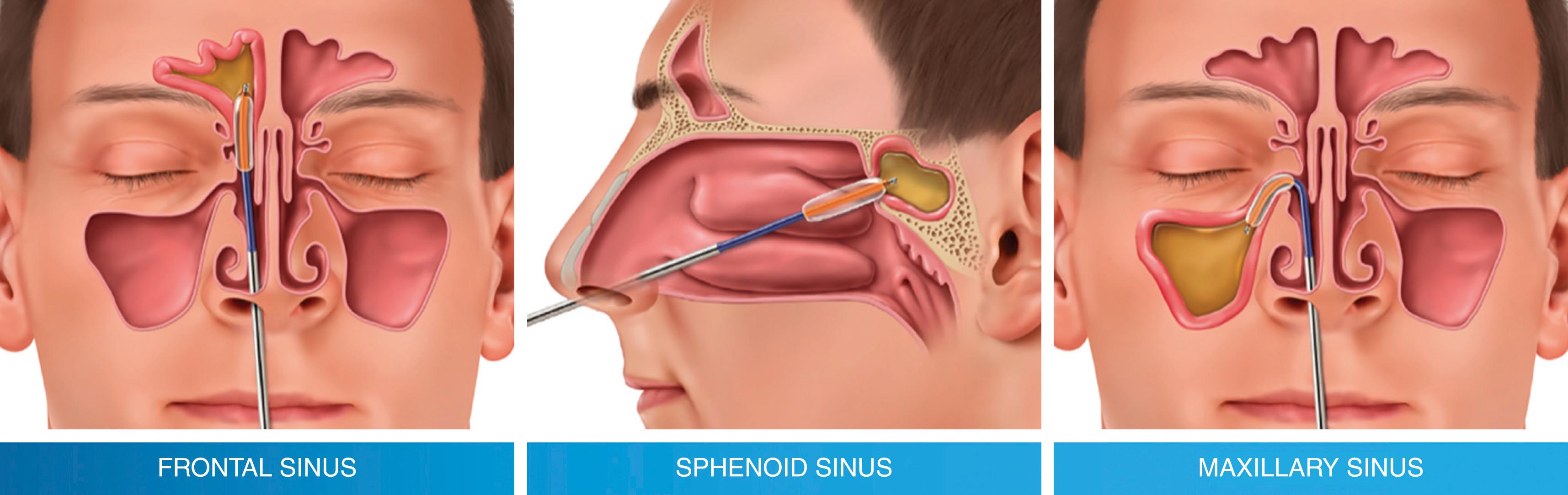 Fig. 102.1, Balloon sinus dilation of major sinuses.