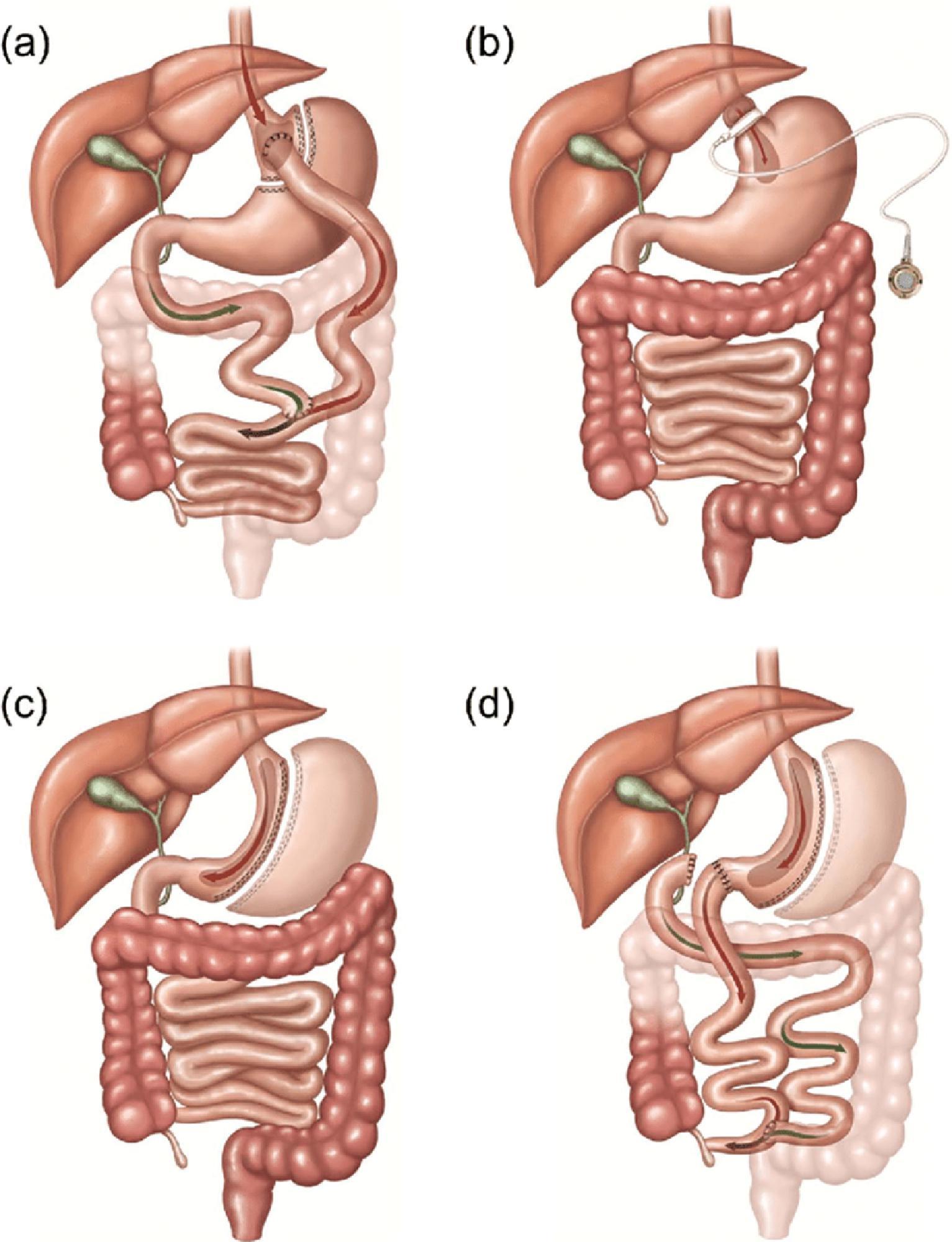 Fig. 11.1, Major types of bariatric surgery. (A) Roux-en-Y gastric bypass. (B) Adjustable gastric band. (C) Sleeve gastrectomy. (D) Biliopancreatic diversion. (Reprinted with permission from Neff KJ, Olbers T, le Roux CW. Bariatric surgery: the challenges with candidate selection, individualizing treatment and clinical outcomes. BMC Med 2013;11:8.)