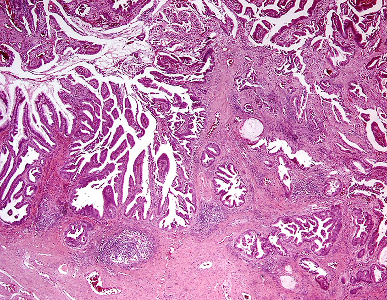 Fig. 18.2, Bartholin gland adenocarcinoma showing papillary and glandular patterns.