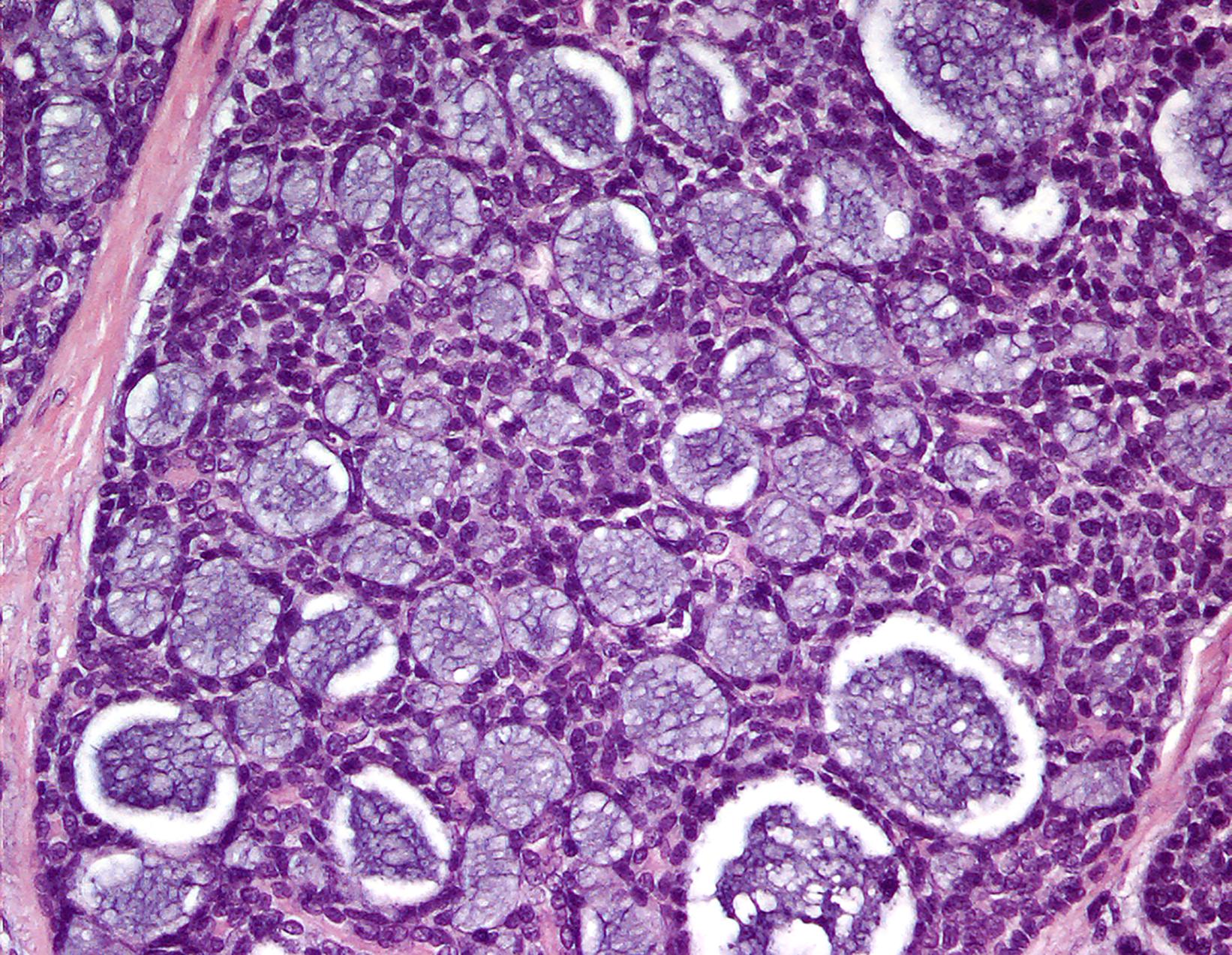 Fig. 18.3, Adenoid cystic carcinoma with uniform small cells in a cribriform and cystic pattern, filled with acellular basement membrane-like material.