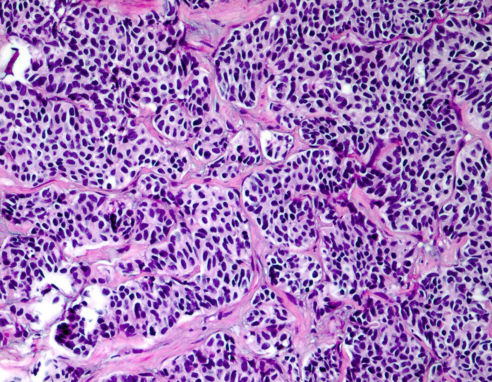 Fig. 18.4, Neuroendocrine carcinoma with monotonous small cells and ovoid, hyperchromatic nuclei.