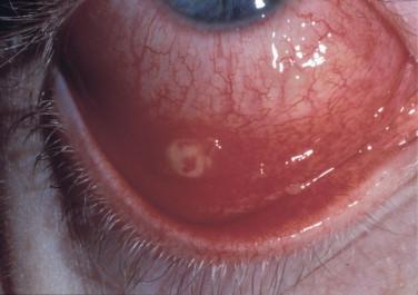 Figure 18-1, Lesion on the bulbar conjunctiva representing an ocular inoculation of B. henselae bacteria.