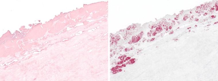 Figure 18-11, Aortic valve showing abundant fibrinous and necrotic debris in the absence of inflammation (left); same field showing innumerable extracellular B. henselae bacteria comprising multiple microcolonies throughout the involved tissue (right). Hematoxylin and eosin stain (left) and immunoalkaline phosphatase with monoclonal anti- B. henselae antibody and hematoxylin counterstain (right), original magnifications 50 ×.