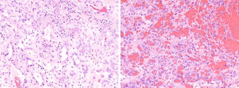Figure 18-12, Cutaneous bacillary angiomatosis showing small, irregular vascular spaces with rounded margins, lined by plump cells with large dark nuclei and prominent nucleoli. The intervening stroma appears loose and mucinous and contains collections of neutrophils (left). The vascular spaces may be dilated and filled with blood (right), which imparts a violaceous appearance to the gross lesion. Hematoxylin and eosin stain, original magnifications 50 ×.