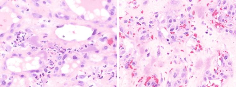 Figure 18-13, Amorphous aggregates of hazy granular material distributed in the stroma of cutaneous bacillary angiomatosis, often in proximity to small clusters of neutrophils (left), and proliferating endothelial cells (right). Hematoxylin and eosin stain, original magnifications 100 ×.