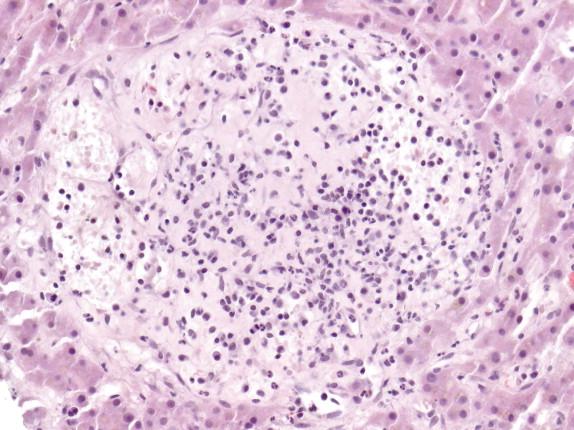 Figure 18-15, Peliotic bacillary angiomatosis in the liver showing a small circumscribed lesion comprising blood-filled spaces lined by flattened endothelial cells and separated by fibromyxoid stroma containing mixed inflammatory cells, neutrophils, and plasma cells. Hematoxylin and eosin stain, original magnification 50 ×.