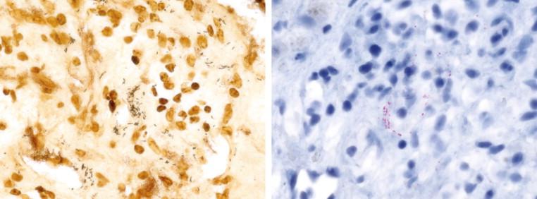 Figure 18-16, Bartonella henselae bacteria in a peliotic hepatic lesion identified by using the Warthin-Starry technique (left) and an immunoalkaline phosphatase technique with monoclonal anti- B. henselae antibody and hematoxylin counterstain (right), original magnifications 158 ×.