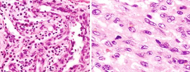 Figure 18-17, Histology of verruga peruana showing vascular channels lined by plump and mildly atypical endothelial cells. Hematoxylin and eosin stain, original magnifications 100 × (left) and 158 × (right).