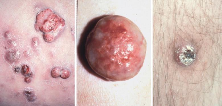 Figure 18-2, Morphologic variations of cutaneous bacillary angiomatosis. Coalescing, dome-shaped papules (left), moist, pedunculated nodules (center), and hyperkeratotic, ulcerated lesions (right).