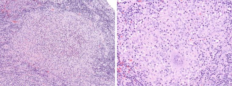 Figure 18-4, Variations in granulomatous lesions involving inguinal lymph nodes of patients with cat scratch disease. A granuloma with loose, centrally located aggregates of neutrophils and fibrin (left), and a non-necrotizing granuloma with multinucleated giant cells (right). Hematoxylin and eosin stain, original magnifications 25 × (left) and 50 × (right).