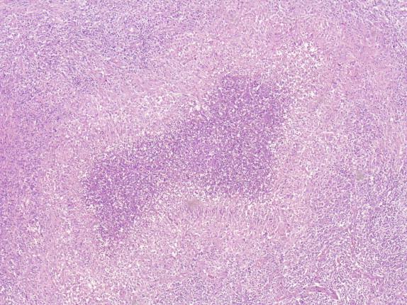 Figure 18-5, Characteristic stellate microabscess in the lymph node of a patient with cat scratch disease showing a contoured collection of neutrophils and necrosis surrounded by a rim of palisading macrophages. Hematoxylin and eosin stain, original magnification 12.5 ×.