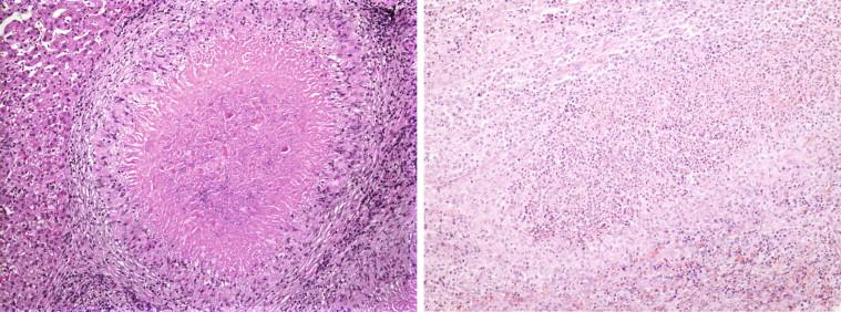 Figure 18-8, Necrotizing granulomatous lesions of hepatosplenic cat scratch disease. Granulomas in the liver are often surrounded by a zone of fibrosis and granulation tissue (left) that is absent from lesions involving the spleen (right). Hematoxylin and eosin stain, original magnifications 25 ×.