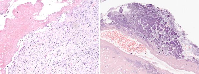 Figure 18-9, Histologic appearance of B. henselae endocarditis involving a mitral valve, with a small fibrin vegetation loosely attached to granulation tissue that contains sparse mixed inflammatory cells (left); an infected aortic valve leaflet with prominent mineralization and scant inflammation (right). Hematoxylin and eosin stain, original magnifications 25 × (left) and 50 × (right).