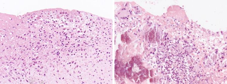 Figure 18-10, Aortic valve excised from a patient with B. vinsonii berkhoffii endocarditis, showing predominantly mononuclear inflammatory cell infiltrates (left); an aortic valve removed from a patient with B. henselae endocarditis, showing mineralized tissue with mixed infiltrates comprising neutrophils and multinucleated giant cells (right). Hematoxylin and eosin stain, original magnifications 50 ×.