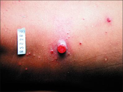 Figure 25-3, Another verruga peruana, mular type. Similarities to pyogenic granuloma and bacillary angiomatosis are evident.