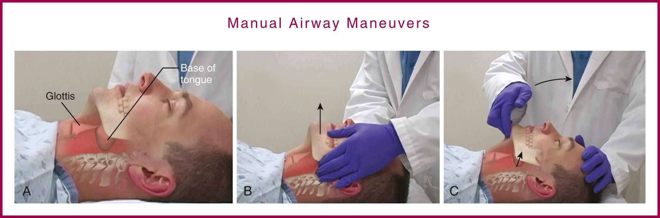 Figure 3.1, Manual airway maneuvers. A, The most common cause of airway obstruction in an unconscious patient is the tongue. Initial maneuvers for opening the airway include B, head tilt/chin lift and C, jaw thrust. The jaw-thrust maneuver is the most important technique.