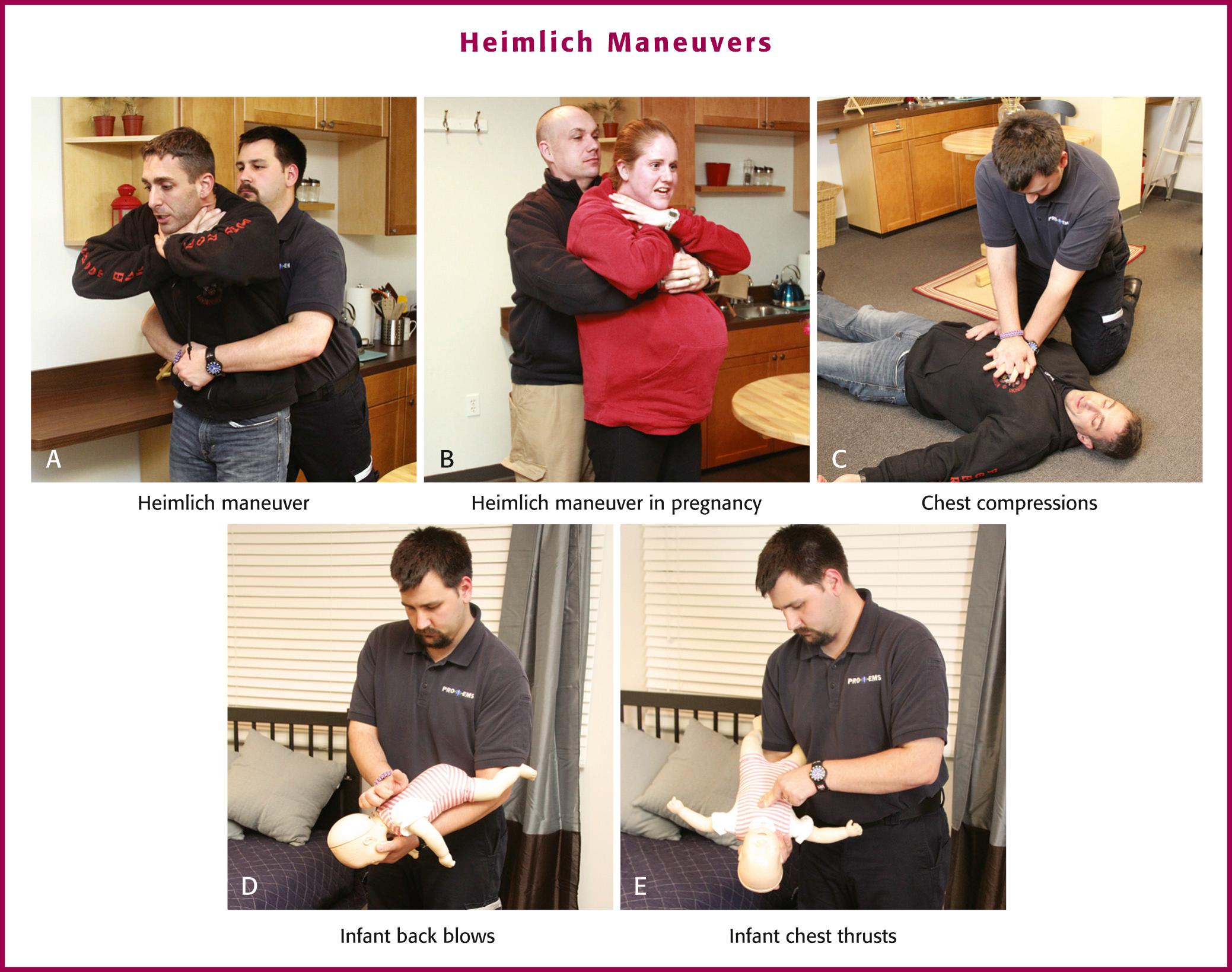 Figure 3.3, A-E, Heimlich maneuvers (see text).