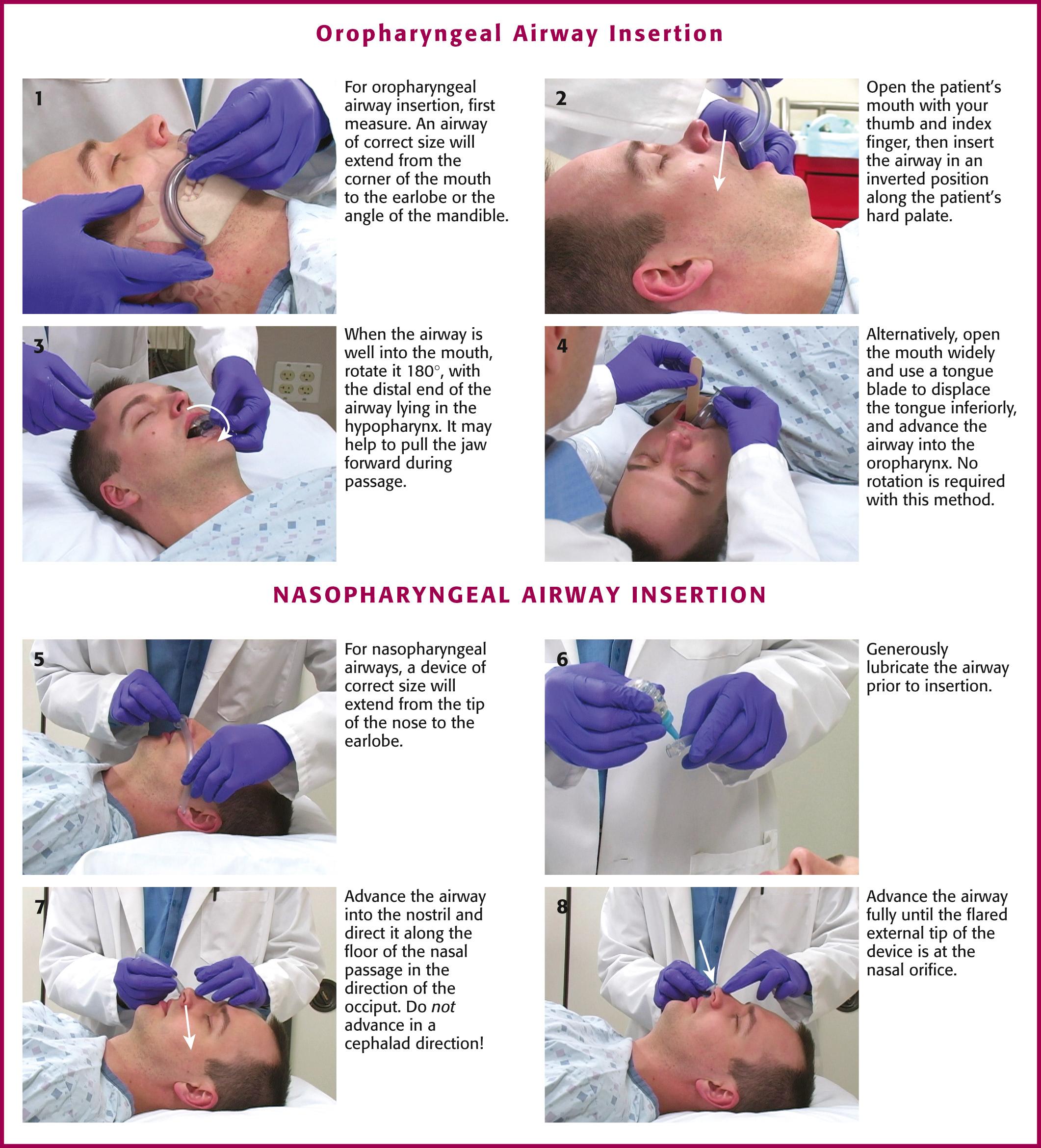 Figure 3.5, Oropharyngeal and nasopharyngeal airway insertion.