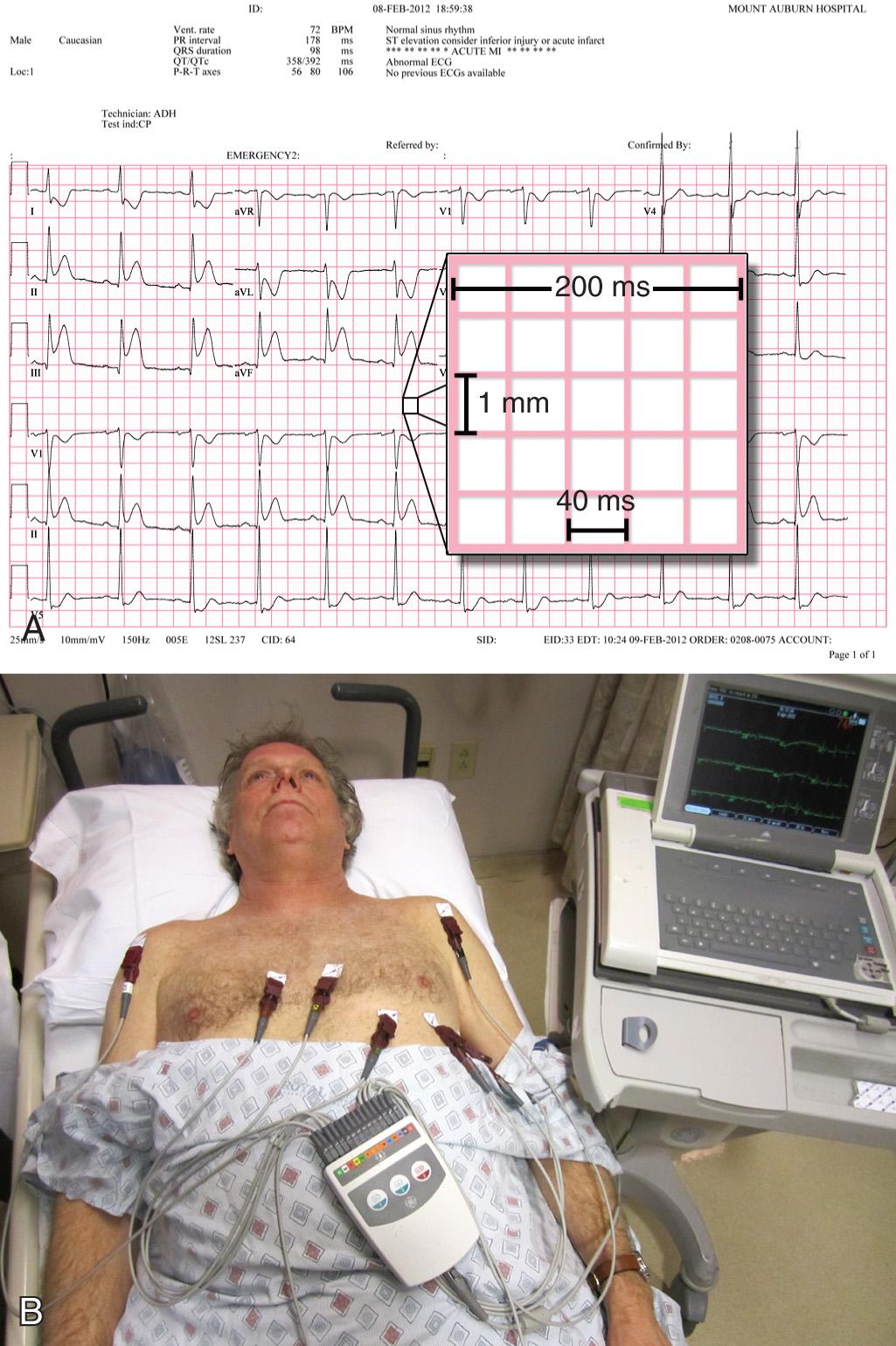 Figure 14.1, A, Standard electrocardiographic (ECG) tracing. By convention, the thick lines are 5 mm apart, and the thin lines (barely visible on this reproduction) are 1 mm apart. At the standard paper speed of 25 mm/sec, each vertical thin line represents 0.04 sec (40 msec) and each vertical thick line represents 0.20 sec (200 msec). (The inset represents one “big box,” which is outlined by thick lines 5 mm apart.) B, Standard 12-lead ECG machine. Note the color coding of the leads.