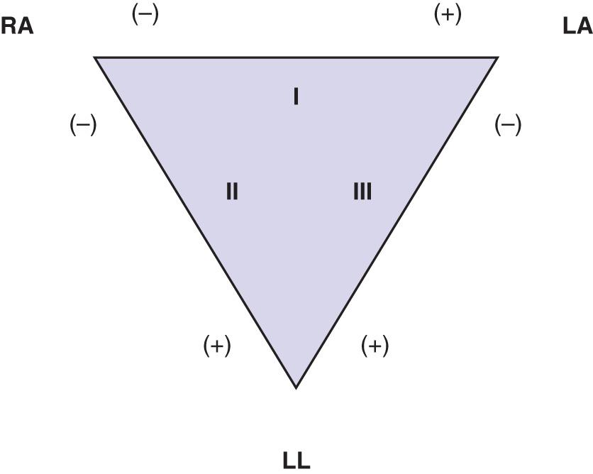 Figure 14.2, Bipolar limb leads. Leads I, II, and III are shown as a triangle, known as Einthoven's triangle . Left arm (LA), right arm (RA), and left leg (LL) placement is shown. Orient these bipolar leads so that the positive poles lie inferiorly and to the left (given that the bottom apex of the triangle is directed toward the left leg), as does the major electrical vector of the heart.