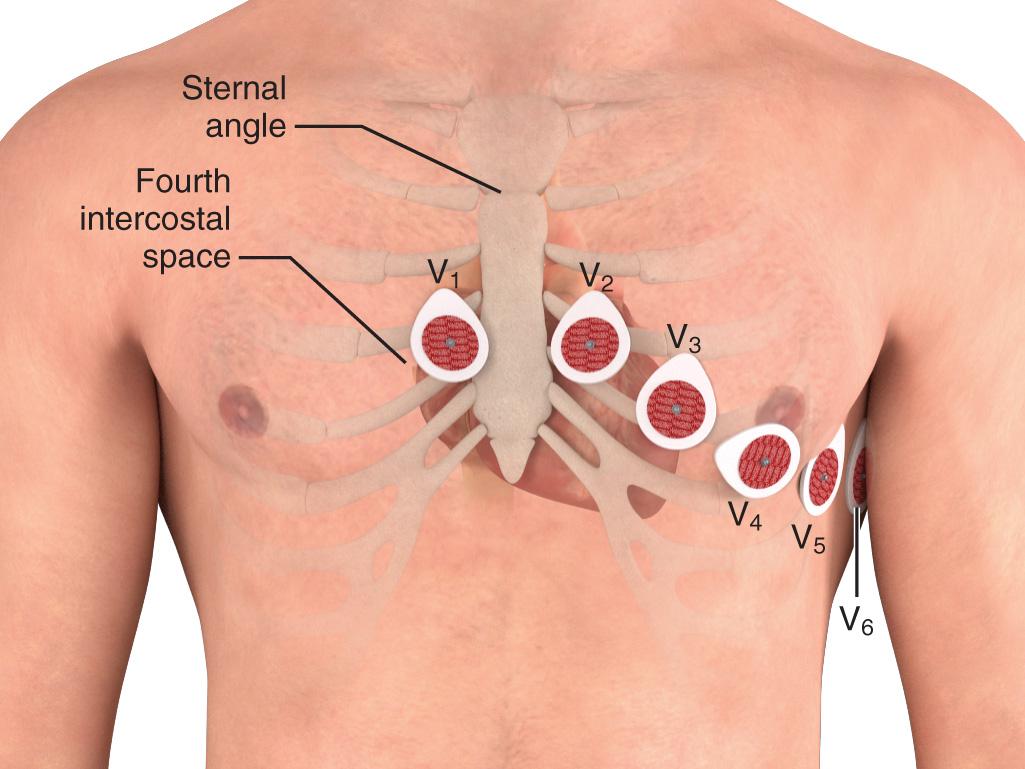 Figure 14.4, Normal precordial (V 1 –V 6 ) lead placement for the standard 12-lead electrocardiogram. If multiple or repeated electrocardiographic tracings are anticipated, mark the original lead placements on the patient's chest wall or leave stick-on leads in place after the electrocardiographic wires are removed.