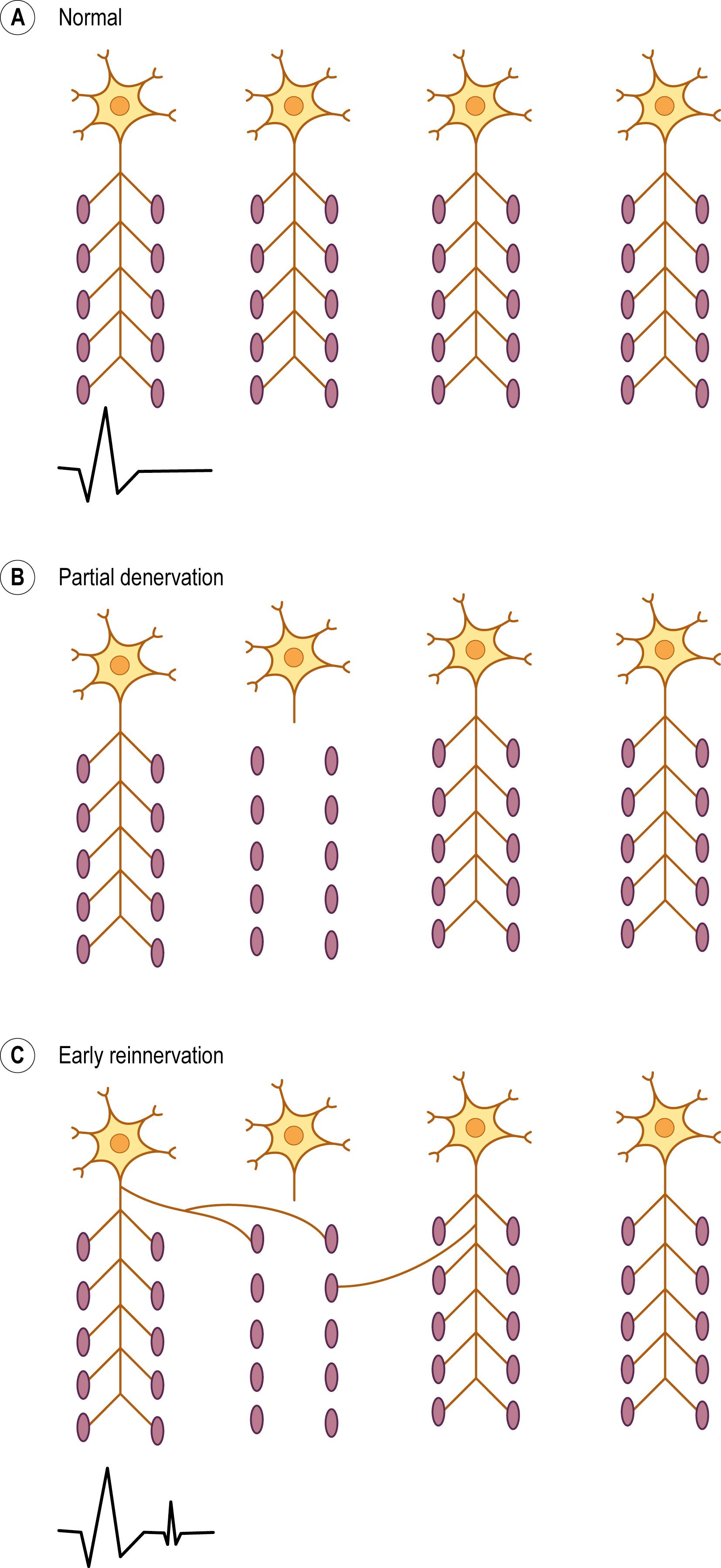 Fig. 15.6, Collateral sprouting and satellite potentials.