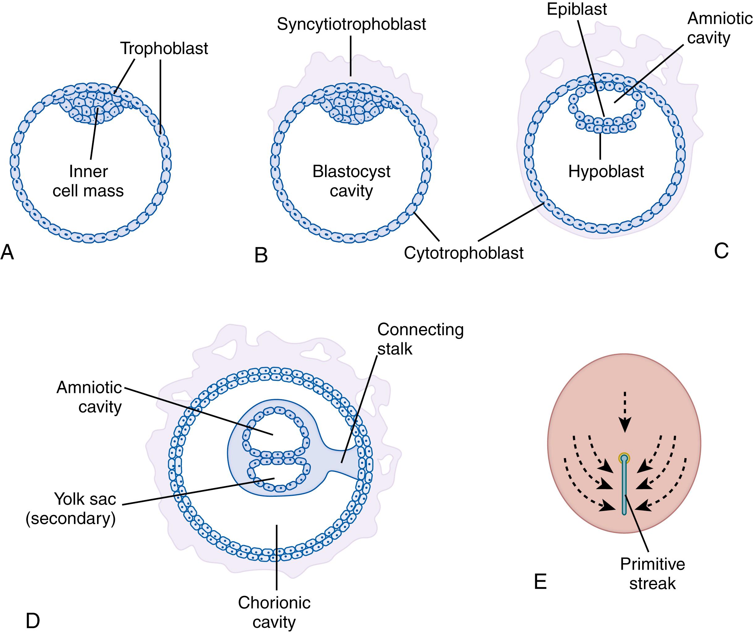 Fig. 3.4, Development of the blastocyst embryonic disk. (A) Blastocyst-stage human embryo, exhibiting the inner cell mass as a regionalized mass of cells projecting into the blastocyst cavity. The cavity is surrounded by trophoblast cells. (B) Blastocyst slightly older than that shown in A. At this time the inner cell mass and trophoblast cells are capped by cells of the syncytiotrophoblast, which are buried in the endometrial stroma (not shown). The cellular layer of trophoblast is now called the cytotrophoblast . (C) An older blastocyst-stage human embryo. The cavity is now surrounded by a double-layered membrane, and the inner cell mass has developed into a bilayered embryonic disk capped by a cavity (amniotic cavity). (D) This somewhat older, completely implanted embryo now exhibits cavities both above and below the embryonic disk, the amniotic cavity, and the yolk sac. No axial features are present in the disk at this time; cephalic and caudal regions cannot be discerned. (E) Surface view of the embryonic disk, showing the primitive streak. This midline thickening of epiblast cells occurs during the early part of the third week after fertilization and produces a landmark (the primitive streak) that delineates the midline of the embryo and reveals the future cephalic and caudal ends. The thickening of epiblast cells in the midline (primitive streak) is actually an increased population of cells in this region, resulting from both a high mitotic rate in the midline and migration of a subpopulation of epiblast cells to a midline position. The arrows indicate migration of the epiblast cells.