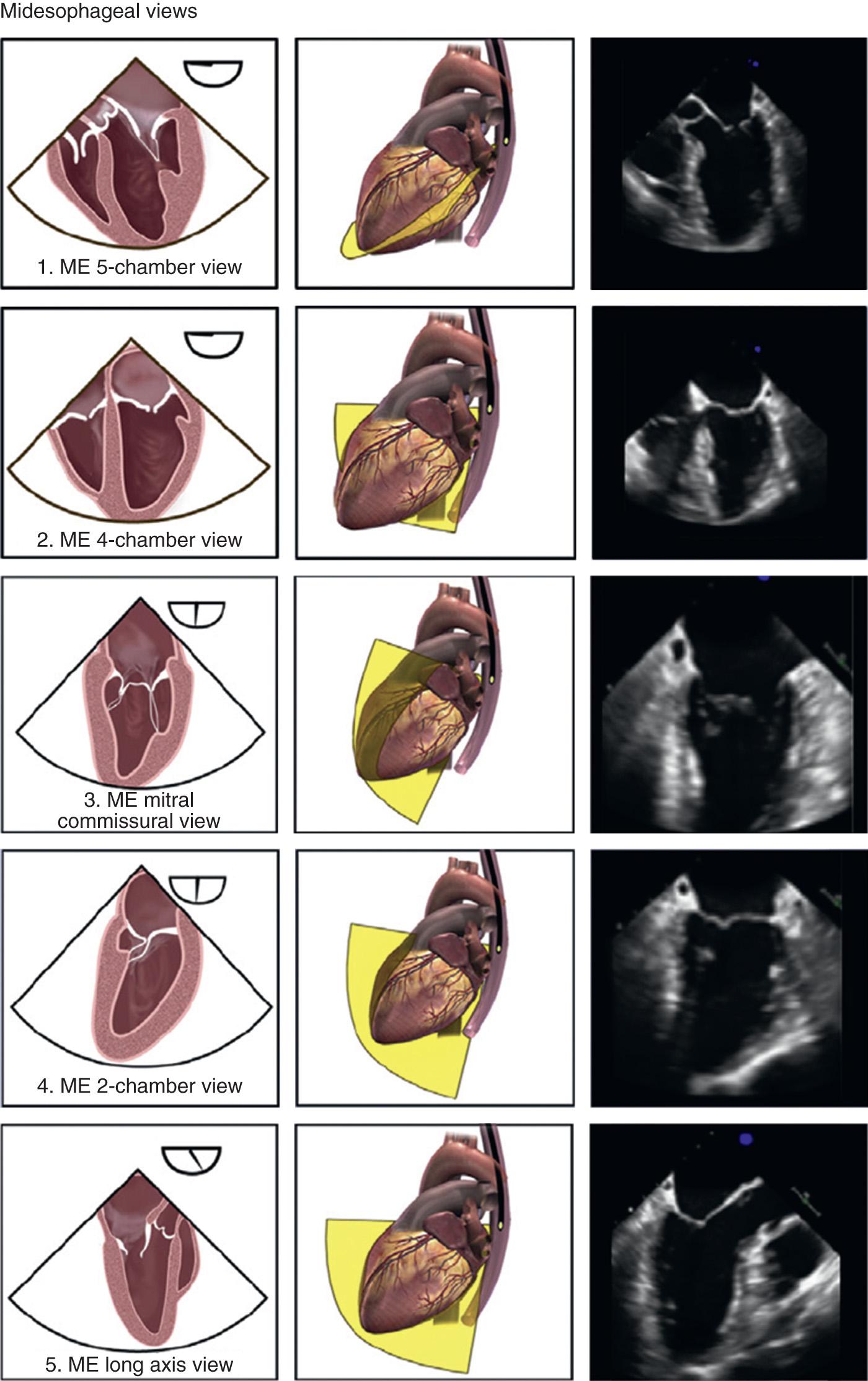 Fig. 11.2, Schematic drawings of the comprehensive examination. AV, Aortic valve; LAX, long axis; ME, midesophageal; RV, right ventricle; SAX, short axis; TG, transgastric; UE, upper esophageal.