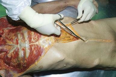 Figure 4-1, After the initial Y -shaped incision has been made and the skin and subcutaneous tissues over the chest have been reflected, scissors are used to open the peritoneal cavity.