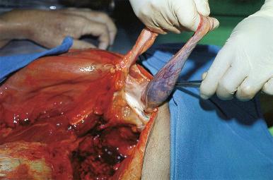 Figure 4-11, In the male, the testes are removed through the peritoneal cavity by entering the scrotal sac through the inguinal canal from above the pubic ramus. The testis and spermatic cord are pulled up and out of the inguinal canal, and the cord is cut.