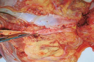 Figure 4-12, Posterior view of the organ block with superior to the left, inferior to the right. The inferior vena cava has been opened to the level of the diaphragm, and the aorta is being opened along its posterior aspect.